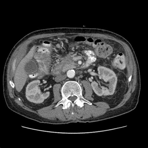 File Journey Through Necrotizing Pancreatitis Presentation Walled Off Necrosis Complicated By