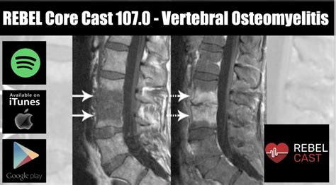 Rebel Core Cast Vertebral Osteomyelitis Med Tac International