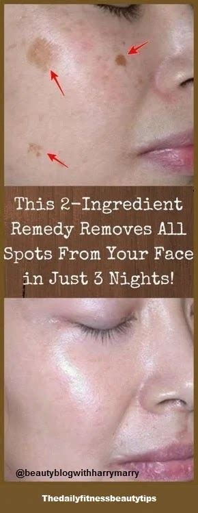 This 3 Ingredient Remedy Removes All Spots From Your Face In Just 3 Nights