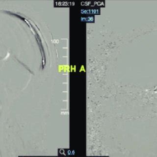 MRI CINE showed pre (Left) and postoperative (Right) CSF flow at ...