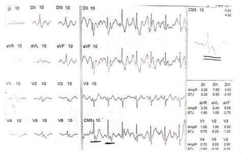 Ecg Durante O Esforço Mostrando Infradesnivelamento De St Em Cm5 De