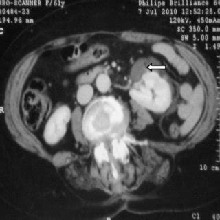 (PDF) Spontaneous calyceal rupture caused by a ureteral calculus