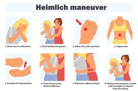 Heimlich Maneuver Infographic Poster With Steps Of First Aid Stock Illustration Illustration