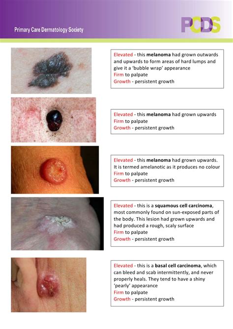 Different Types Of Skin Cancer Moles