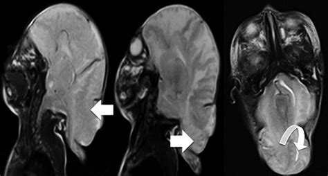 Arnold Chiari Malformation Type