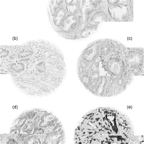 Pituitary Tumor Transforming Gene 1 Protein Pttg1 Immunostaining And