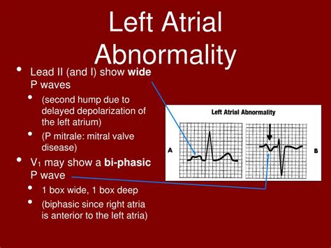 Ppt Atrial And Ventricular Enlargement Powerpoint Presentation Free Download Id 4202816