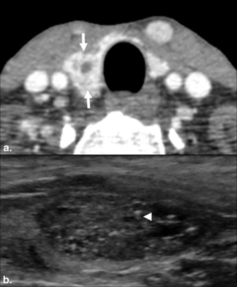 Thyroid Lesions Visualized On Ct Academic Radiology