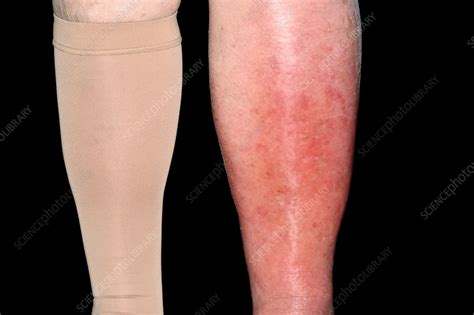 Cellulitis Edema Legs