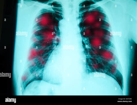 Radiografia Toracica Immagini E Fotografie Stock Ad Alta Risoluzione