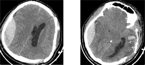 Post Operative Ct Scan Showing A Large Right Extradural Hematoma With