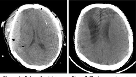 Figure 1 From Disseminated Intravascular Coagulation Developing After Cranioplasty Semantic