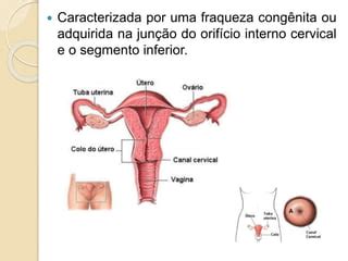 Defici Ncia Istmo Cervical E Placenta Pr Via Ppt