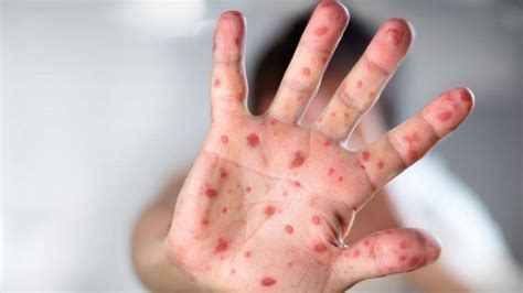 Monkeypox Symptoms Diagnosis Treatment Prevention