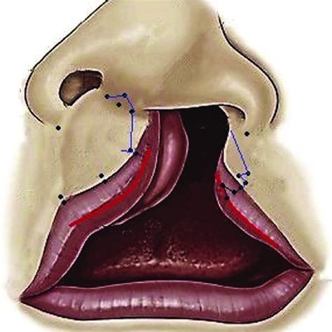 Pdf Comparative Evaluation Of Aesthetic Outcomes In Unilateral Cleft