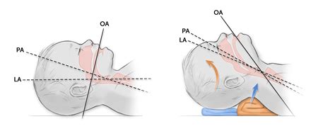 Tracheal intubation – Online supplement