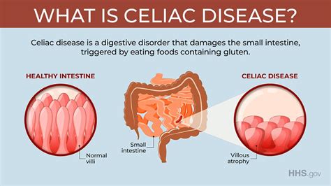 Celiac Disease And Alcohol - Quotes Viral