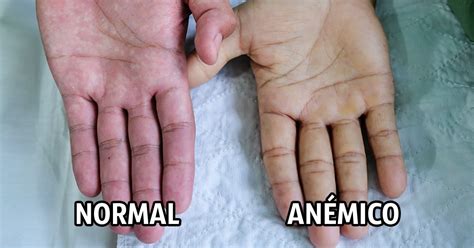 Signos De Anemia Y Tratamientos Para Estos Que Quiz S No Conozcas