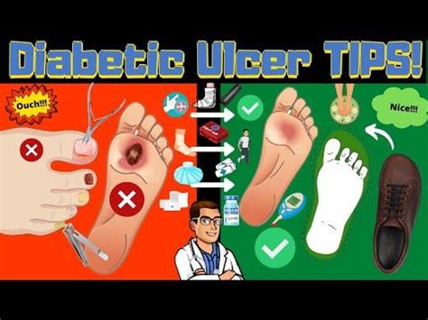 Diabetic foot pain symptoms and treatment diabetes foot pain – Artofit