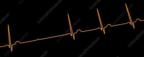 ECG with second degree Mobitz 2 AV block, illustration - Stock Image ...