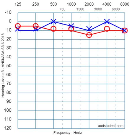 Audiometría ¿qué Es Y Por Qué Es Importante Bienestaraudio