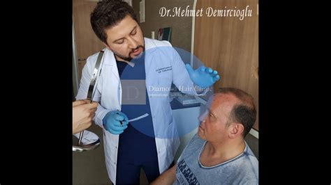 Hair Transplant Turkey Istanbul Dr Mehmet Demircioglu Directly