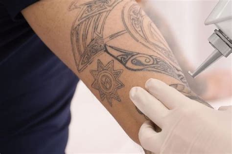 Como Eliminar Un Tatuaje Formas