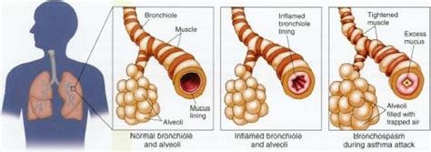 Bronchitis Net Health Book