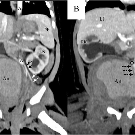 Coronal Non Angiographic Ct Images At Level Of Aortic Bifurcation A