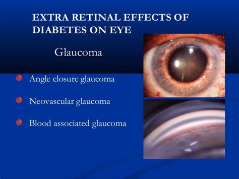 Glaucoma And Diabetes - DiabetesWalls