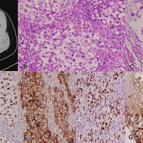 Malignant Mixed Germ Cell Tumor Of The Ovary A Ct Scan Showing The Download Scientific