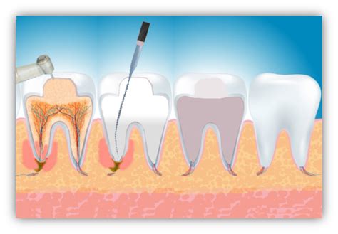 Ortodonzia Sei Cose Da Sapere Sulla Devitalizzazione Dei Denti