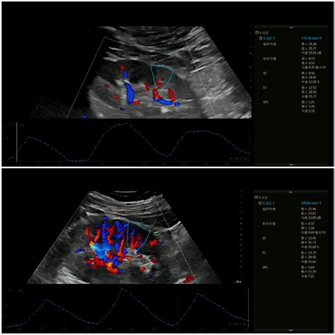 Images Taken By Color Doppler Ultrasound Above Is The Color Doppler