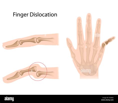 Dislocated finger hi-res stock photography and images - Alamy