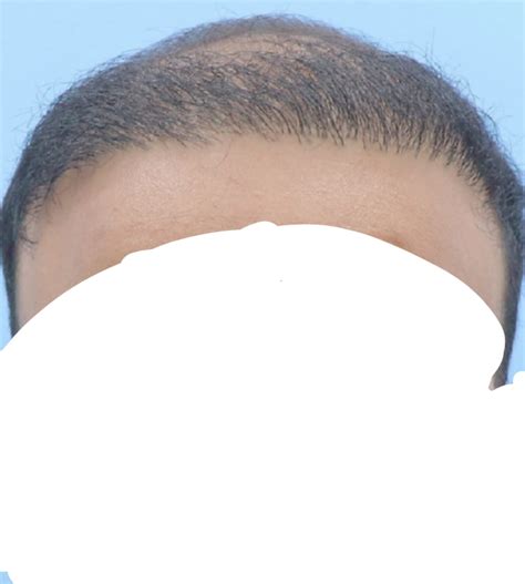 When The Urine Tests Come Knocking: 5 Proven Ways To Pass A Hair Follicle Test Asap