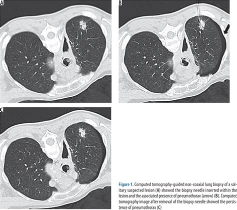 Figure 1 From Risk Factors Of Pneumothorax And Chest Tube Placement After Computed Tomography