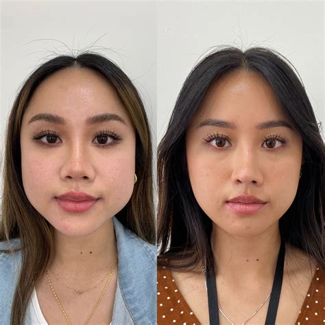 PDO Threads Lift in Orange County & Newport Beach CA | Beauty Boost Med