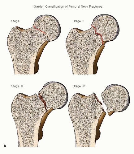 Femoral Neck Fractures Hemiarthroplasty And Total Hip Arthroplasty