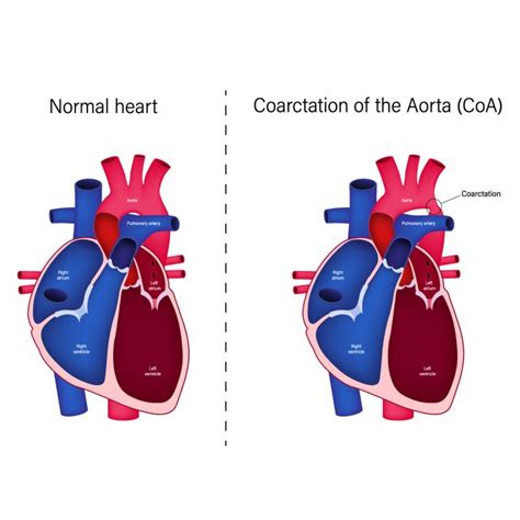 Top 9 Warning Signs Of Aortic Coarctation Vejthani