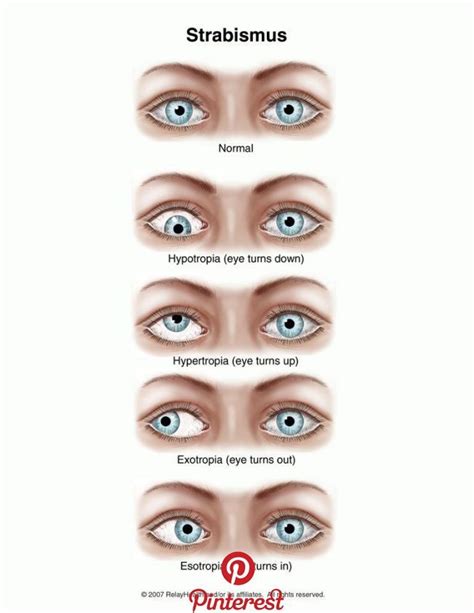 Strabismus Strabismus Is The Inward Deviation Of The Eyes Noted Before The Patient Reaches Age 6