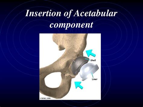 Ppt Hip Arthroplasty Powerpoint Presentation Free Download Id6713349