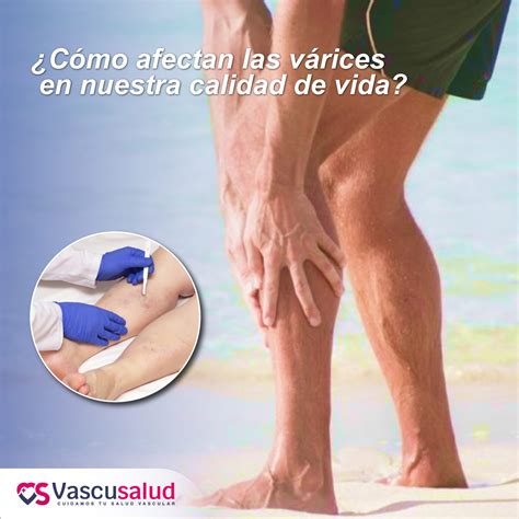 Cómo afectan las varices en nuestra calidad de vida