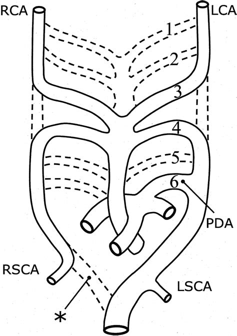 Patent Ductus Arteriosus Circulation