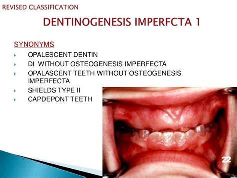 Dentinogenesis Imperfecta