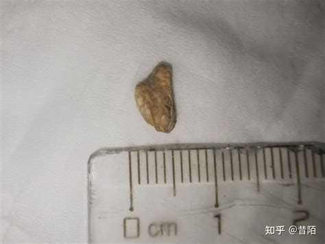 肾结石7毫米可以排出不？ 知乎