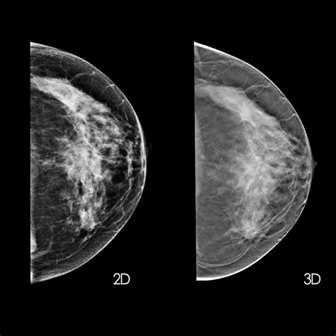 Digital Mammography vs Digital Breast Tomosynthesis in Breast Cancer Screening. – Diagnostic ...