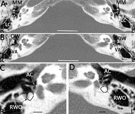 CT image of the inner ear in a patient with bilateral sudden... | Download Scientific Diagram