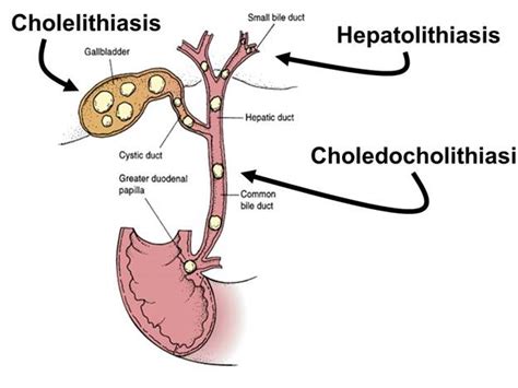 Cholelithiasisgall Stonebatu Empedu Diagnosa Dan Pengobatan