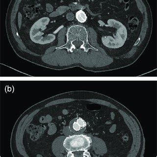 Postoperative Contrast Enhanced Computed Tomography CT A A CT