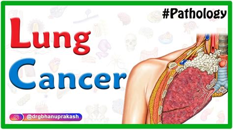 Lung Cancer Pathology Squamous Cell Carcinoma Usmle Neetpg Fmge